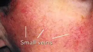 vascular lesions