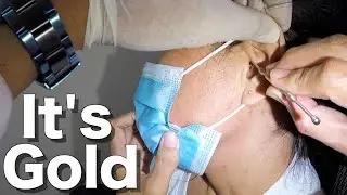 Gold Earwax Nugget Stuck in Woman's Ear