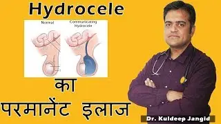 Best treatment of Hydrocele | 100% Permanent treatment of Hydrocele | हीड्रोसेले का इलाज