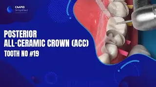 Posterior All-Ceramic Crown (ACC) on tooth no #19 | Full Course on Link Below
