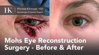 Before & After Cases Mohs Micrographic Reconstruction Surgery of Eyelid | Dr. Hooman Khorasani