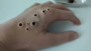 ASMR worm removal.. Warning: Trypophobia triggers, maggot grows out of skin