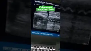 wadna garaaca cunuga(fetal heart rate) 