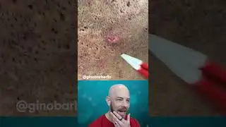 Don’t miss this inflamed ingrown hair plucking🔥 (credit: @ginobarberlic on TT) 
