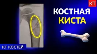 Лучевая диагностика костной кисты