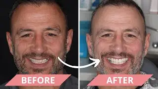 Craig's Smile Makeover Journey With Andy McIntyre