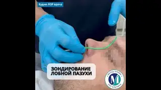 Зондирование лобной пазухи.