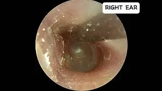 Satisfying Dry Ear Fungus Removal‼️