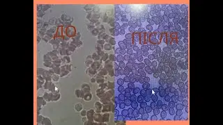 Сахарный диабет первой степени