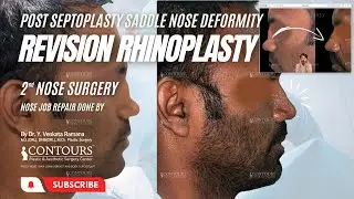 REVISION RHINOPLASTY | SADDLE NOSE DEFORMITY | POST SEPTOPLASTY | CONTOURS PLASTIC SURGERY