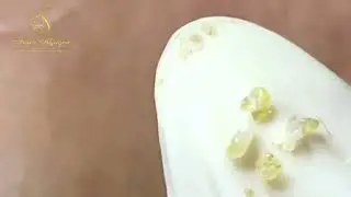 Acne Scars Treatment What Really Works