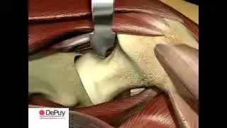 Hip Replacement using SMITH PETERSON APPROACH