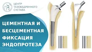 🦿 В чем отличие цементной фиксации от бесцементной? Цементное и бесцементное эндопротезирование. 18+