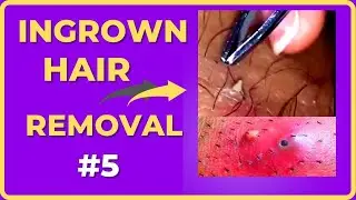 Ingrown hair removal videos [Compilations #5] #RemovalHair #ingrownhair #내성발톱  #ingrownhairShorts