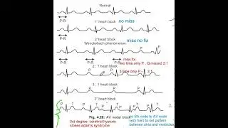 very easy explanation of incomplete vs complete heart block