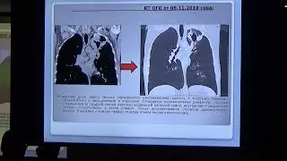 Бронхо 30 07 Наумова ТА Эндоскопическое лечение крупной каверны с бронхом пораженным ТБ