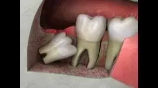 Wisdom Teeth Removal, Extraction, Impaction