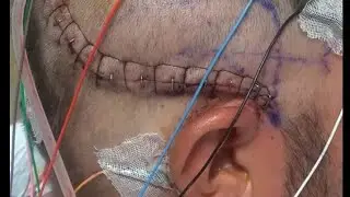 Quick Health Update 10/15/24 Brain cancer is going down and to God be the glory for where I am today