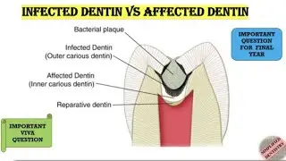 Quick Revision of Infected and Affected dentin #dental #dentistry #bds