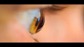 ✅  Surgery Lasik and Keratoconus, can I operate? - FAQS