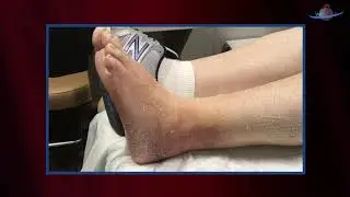 WCW: Using Edema Wear to Manage Multiple Hematomas