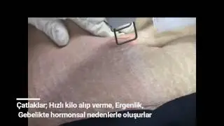 Lazer Cilt Çatlakları Tedavisi