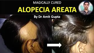 Alopecia Areata (Cured case by SINGLE MEDICINE) || Wonderful #Homoeopathy ||