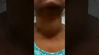 Thyroid swelling moves with deglutition