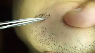 Hair removal asmr pull out with Tweezers  Satisfying pull out beard 10min 202408d