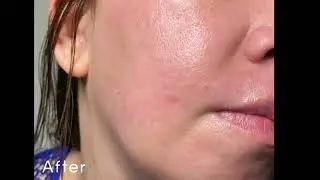 BEFORE AFTER PAKE SKIN CARE PUNYA EFEK BOTOX, CHECK