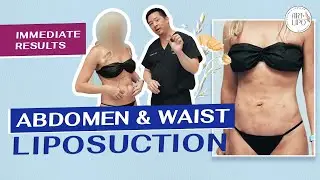 Abdomen & Waist Liposuction | Immediate Results | Minimal Downtime | Artlipo | Expert Dr. Thomas Su