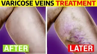 Why Your Varicose Veins Won’t Go Away: 5 Key Reasons