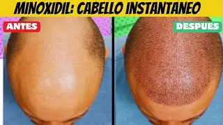 💊  MINOXIDIL: ❌Efectos Secundarios 👉Como USAR, Para que SIRVE 👀Supera la CALVICIE 🚀 y la ALOPECIA