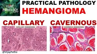 HEMANGIOMA: capillary & Cavernous. Clinical features & Morphology