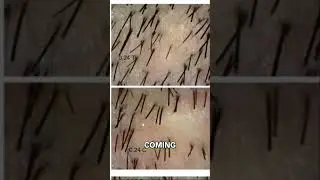 Is Verteporfin Just Hype?