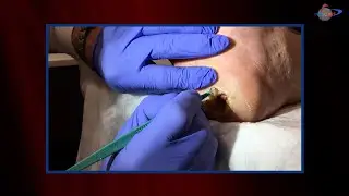 WCW: Removing Callus Caused by Inadequate Offloading
