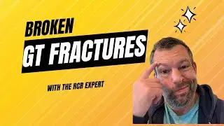 Busted Shoulder: Everything You Need To Know About Greater Tuberosity Fractures