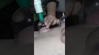 I Had Body Massage And Cupping Therapy In Indonesia 