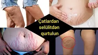 Bedendeki catlar ucun maska