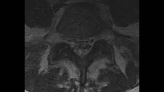 Dilated Epidural Venous Plexus