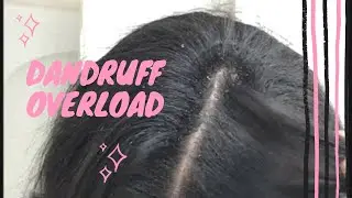 Satisfying Dandruff Scratching| Dry Scalp Scratching