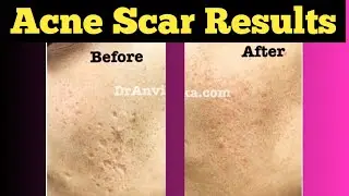 Acne scars treatment with laser / 9999 747 717