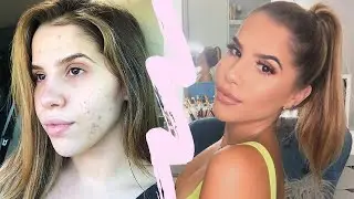 HOW I COVER MY ACNE! | Sophia Perez