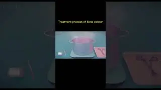 Treatment of bone cancer