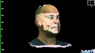 After Jaw Surgery for Sleep Apnea - 3D Imaging Software