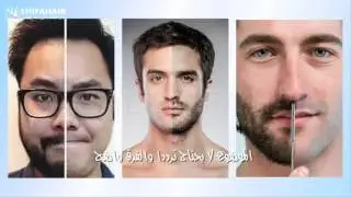 زراعة الشعر الأكثر ضمانا في تركيا للحجز والاستفسار 00905555558555