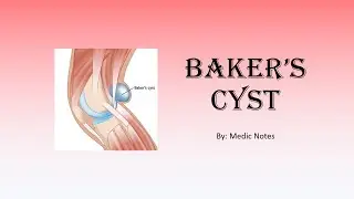 Baker's cyst - causes, signs and symptoms, investigation, treatment