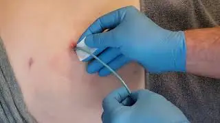 biliary drain stat lock replacement