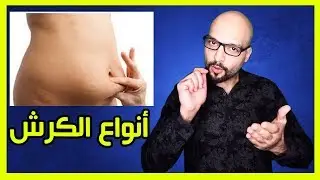 أنواع الكرش و كيف نتخلص منها للأبد | Types of belly fat