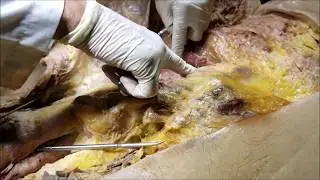 Superficial and Deep Muscles of Gluteal Region – Sanjoy Sanyal